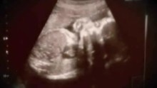 This ultrasound image shows about 22 weeks.