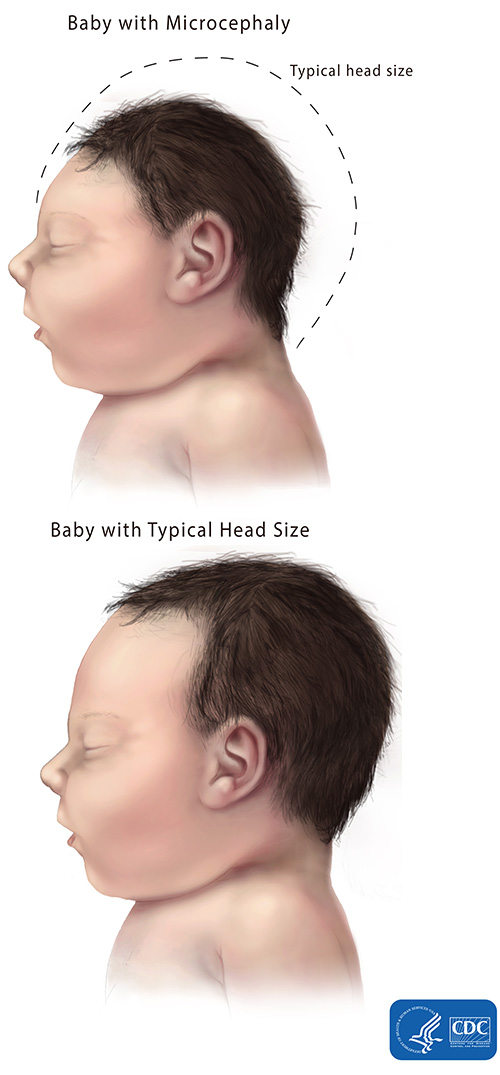 microcephaly-comparison-500px