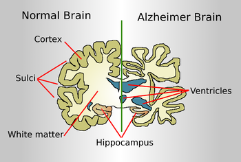 English: Drawing comparing how a brain of an A...