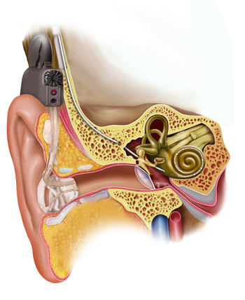 Illustration of Electric Acoustic Stimulation,...