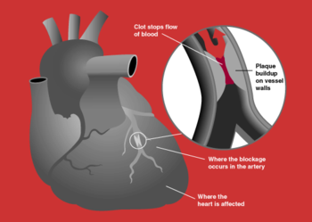 An example of a heart attack, which can occur ...