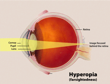 English: Diagram of a human eye with hyperopia