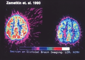 Brainscan of brains with and without ADHD