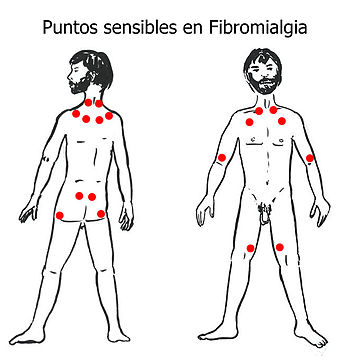 English: Tender Points in Fibromyalgia. Españo...