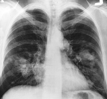 English: This is an x-ray image of a chest. Bo...