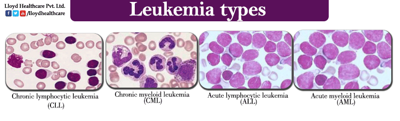 What Type Of Leukemia Is Most Common In Elderly